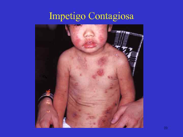 Impetigo Contagiosa 22 