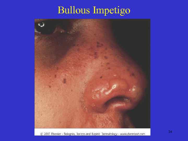 Bullous Impetigo 24 