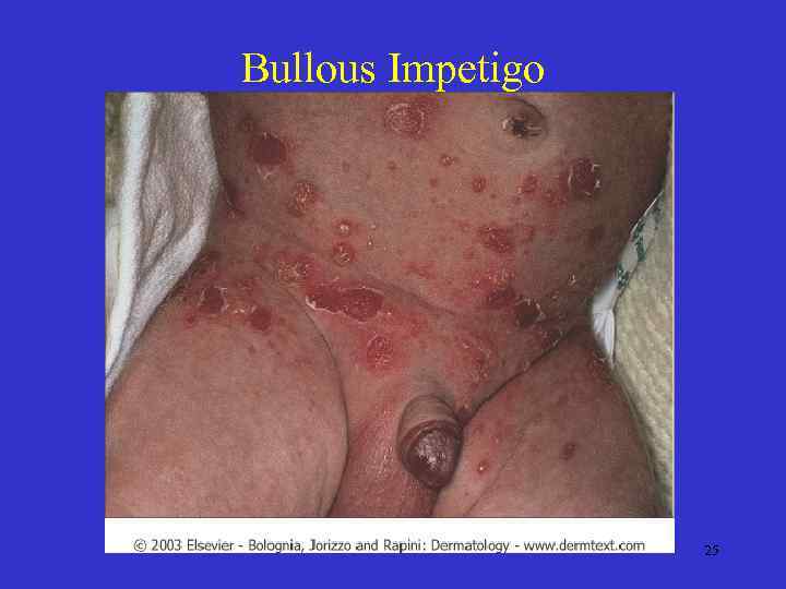 Bullous Impetigo 25 