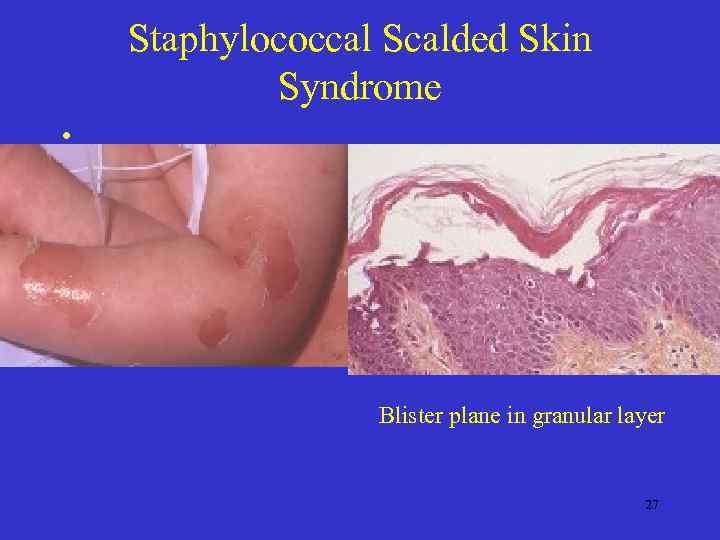 Staphylococcal Scalded Skin Syndrome • Blister plane in granular layer 27 