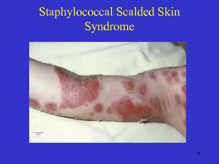 Staphylococcal Scalded Skin Syndrome 28 