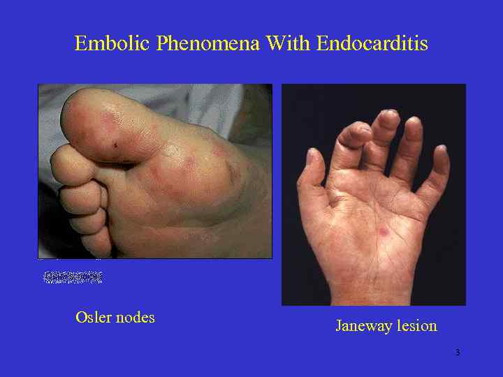 Embolic Phenomena With Endocarditis • Osler nodes Janeway lesion 3 