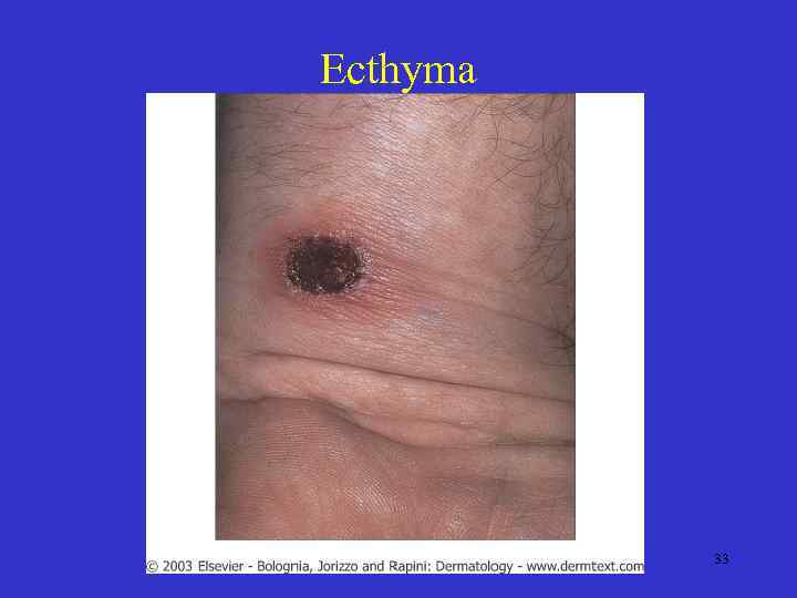 Ecthyma 33 