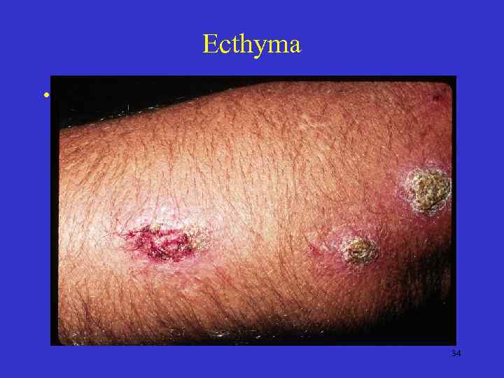 Ecthyma • 34 