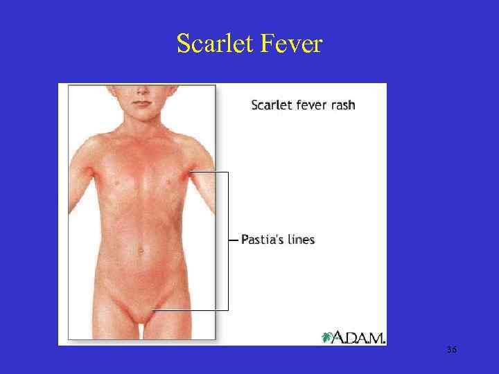 Scarlet Fever 36 