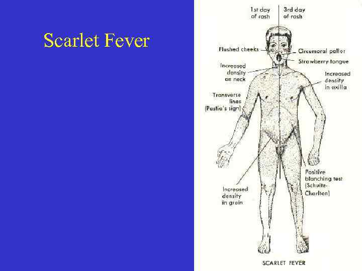 Scarlet Fever 37 