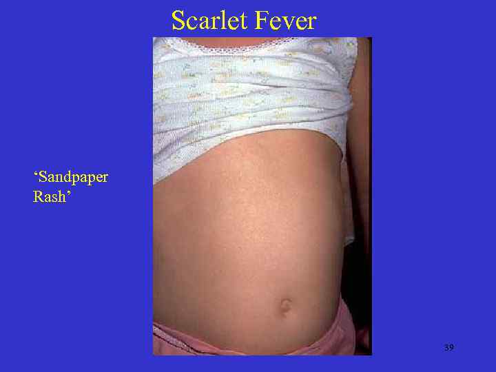 Scarlet Fever ‘Sandpaper Rash’ 39 