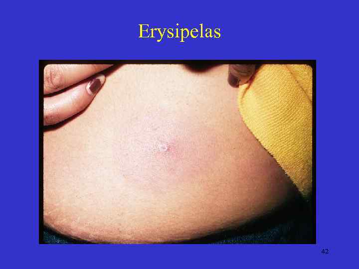 Erysipelas 42 