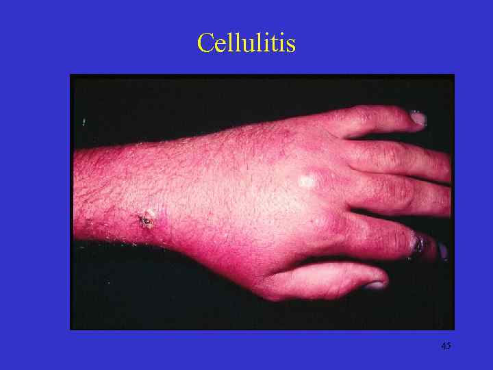 Cellulitis 45 