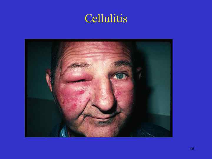 Cellulitis 46 