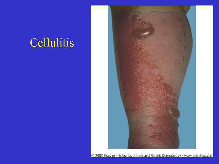 Cellulitis 47 