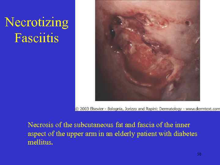 Necrotizing Fasciitis Necrosis of the subcutaneous fat and fascia of the inner aspect of