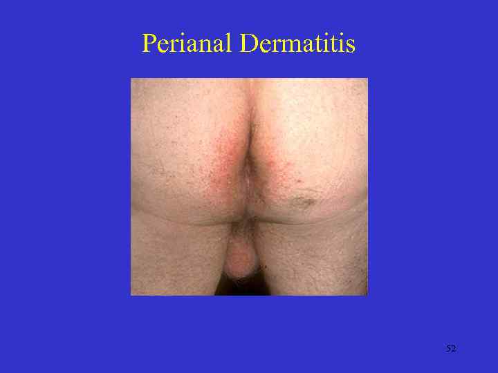 Perianal Dermatitis 52 