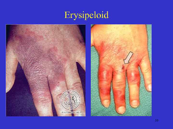 Erysipeloid 55 