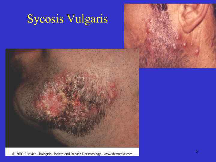 Sycosis Vulgaris 6 