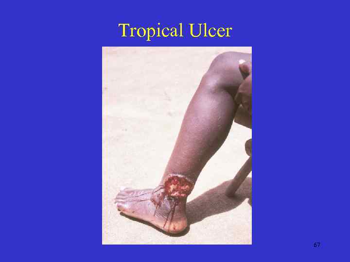 Tropical Ulcer 67 