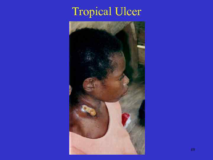 Tropical Ulcer 68 