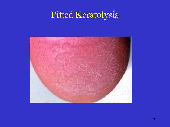 Pitted Keratolysis 76 