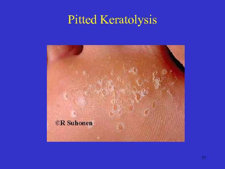 Pitted Keratolysis 77 