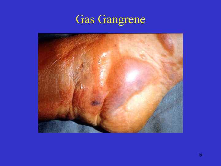 Gas Gangrene 79 