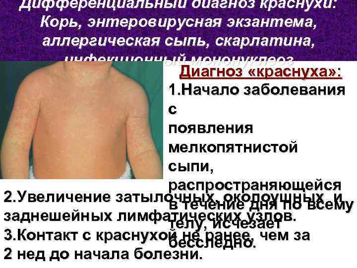 Дифференциальный диагноз краснухи: Корь, энтеровирусная экзантема, аллергическая сыпь, скарлатина, инфекционный мононуклеоз Диагноз «краснуха» :