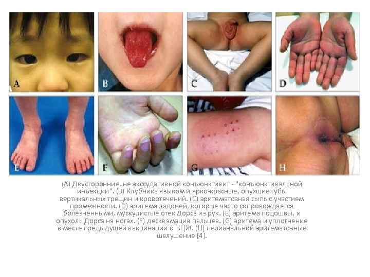 (A) Двусторонние, не экссудативной конъюнктивит - "конъюнктивальной инъекции". (B) Клубника языком и ярко-красные, опухшие