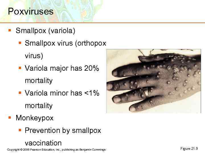 Poxviruses § Smallpox (variola) § Smallpox virus (orthopox virus) § Variola major has 20%