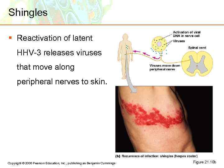 Shingles § Reactivation of latent HHV-3 releases viruses that move along peripheral nerves to