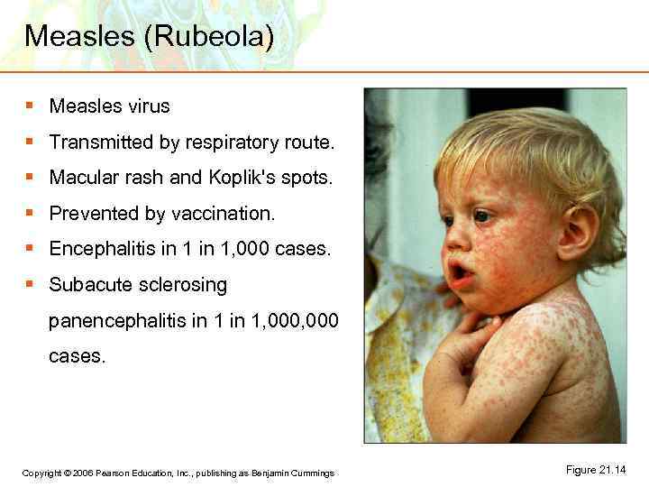 Measles (Rubeola) § Measles virus § Transmitted by respiratory route. § Macular rash and