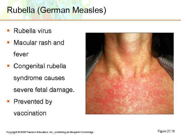 Rubella (German Measles) § Rubella virus § Macular rash and fever § Congenital rubella