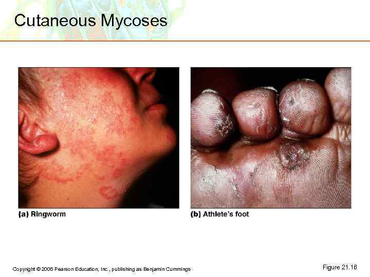 Cutaneous Mycoses Copyright © 2006 Pearson Education, Inc. , publishing as Benjamin Cummings Figure