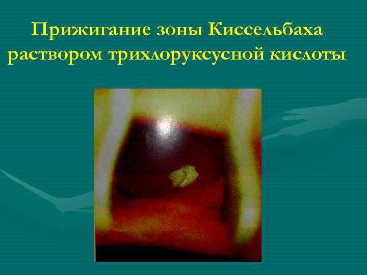 Прижигание зоны Киссельбаха раствором трихлоруксусной кислоты 