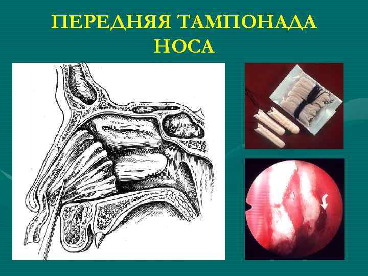 ПЕРЕДНЯЯ ТАМПОНАДА НОСА 