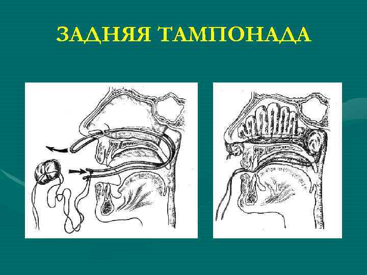 ЗАДНЯЯ ТАМПОНАДА 