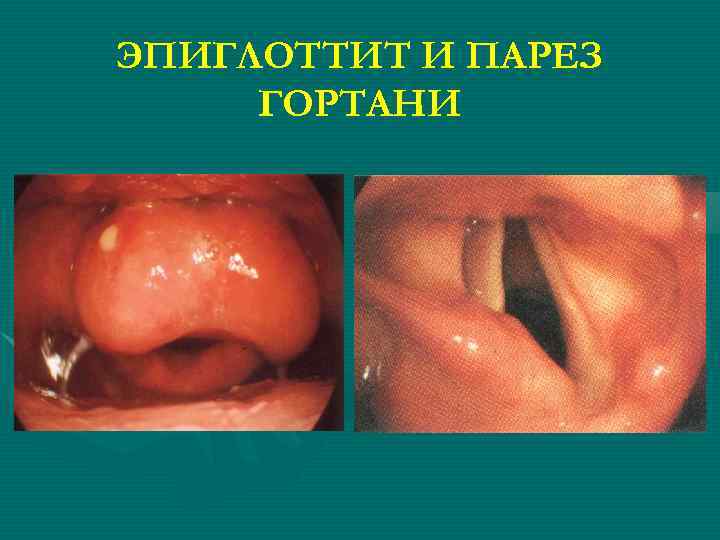 ЭПИГЛОТТИТ И ПАРЕЗ ГОРТАНИ 