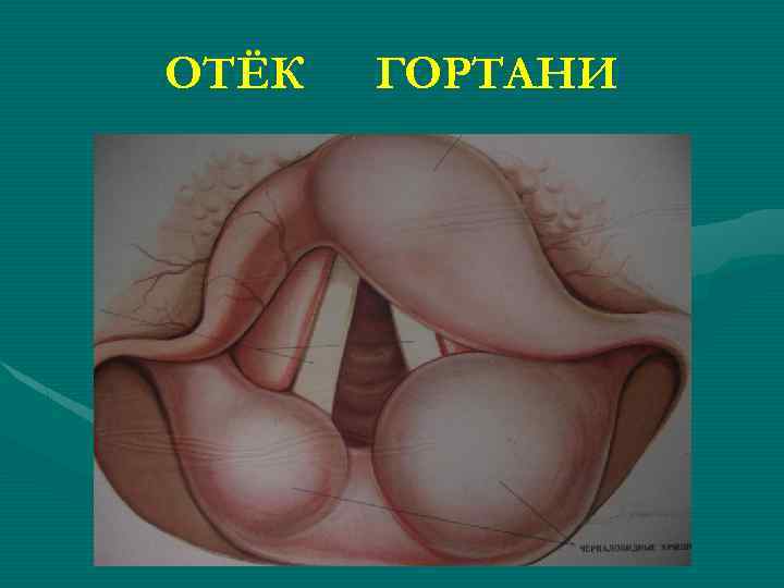ОТЁК ГОРТАНИ 
