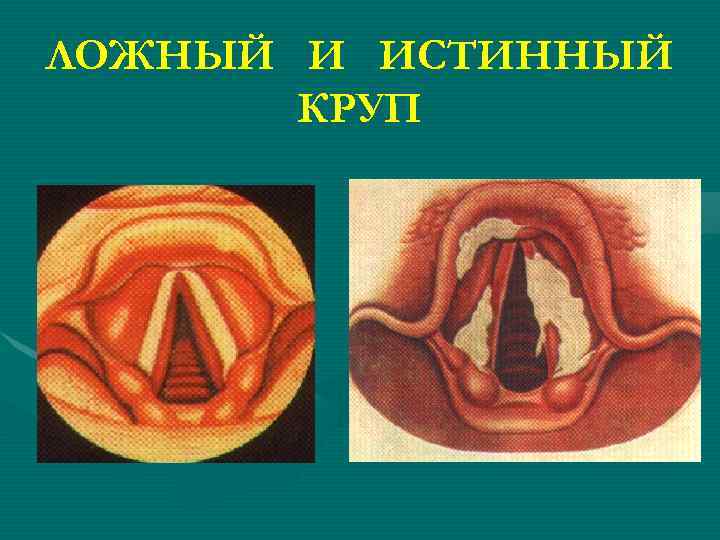 ЛОЖНЫЙ И ИСТИННЫЙ КРУП 