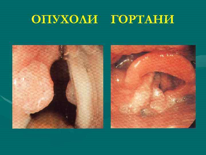 ОПУХОЛИ ГОРТАНИ 