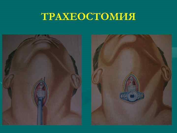 ТРАХЕОСТОМИЯ 