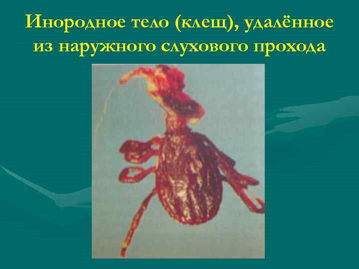 Инородное тело (клещ), удалённое из наружного слухового прохода 