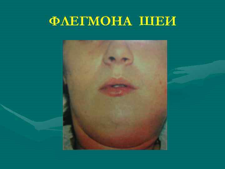 ФЛЕГМОНА ШЕИ 