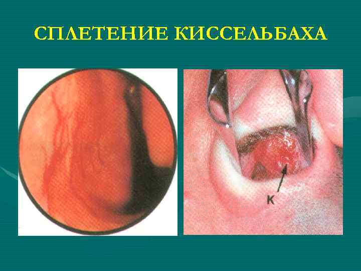 СПЛЕТЕНИЕ КИССЕЛЬБАХА 