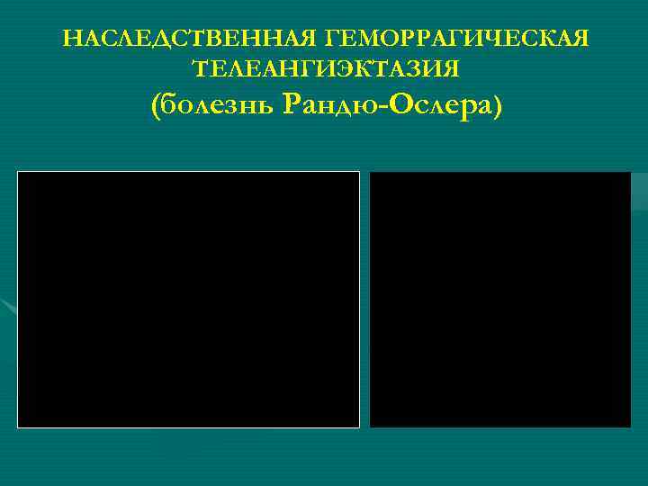 НАСЛЕДСТВЕННАЯ ГЕМОРРАГИЧЕСКАЯ ТЕЛЕАНГИЭКТАЗИЯ (болезнь Рандю-Ослера) 