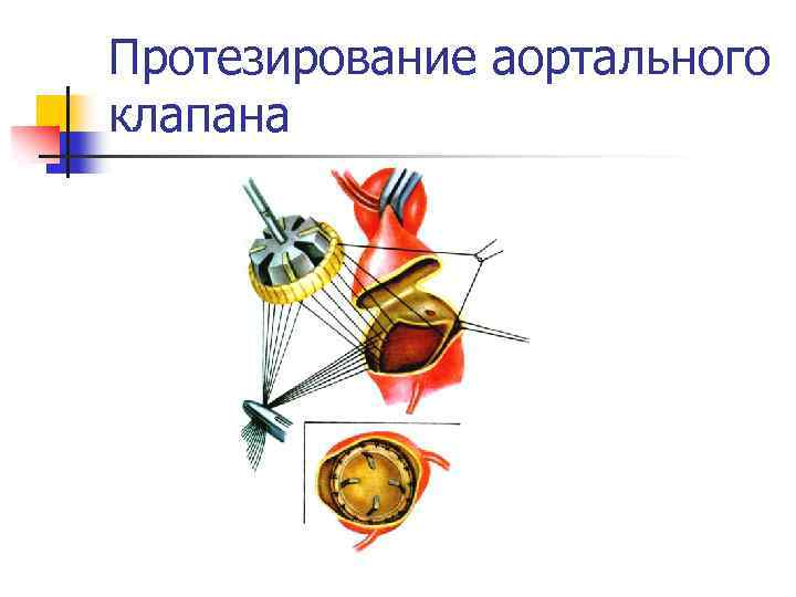 Протезирование аортального клапана 