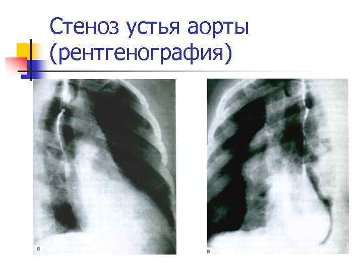 Стеноз устья аорты (рентгенография) 