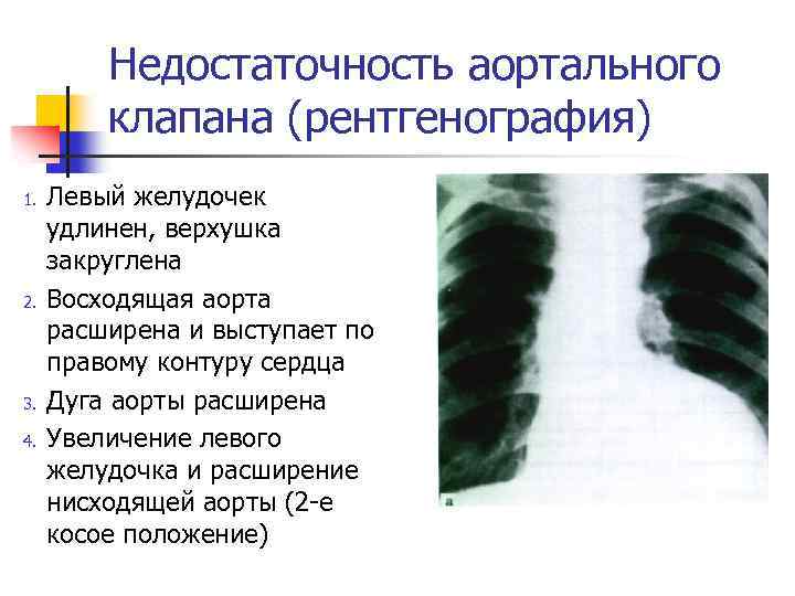 Недостаточность трикуспидального клапана степени