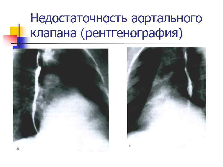 Недостаточность аортального клапана это