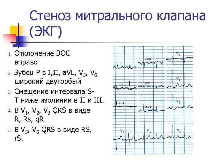 Стеноз митрального клапана (ЭКГ) 1. 2. 3. 4. 5. Отклонение ЭОС вправо Зубец P