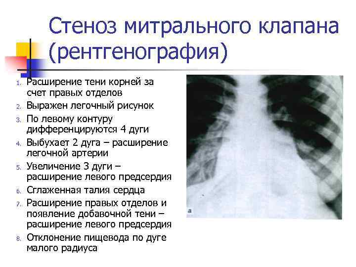 Митральная стеноз презентация