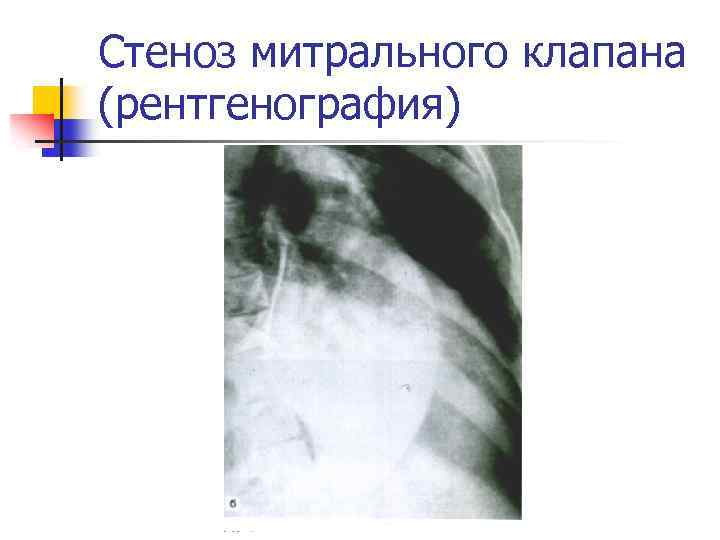 Симптомы регургитации митрального клапана